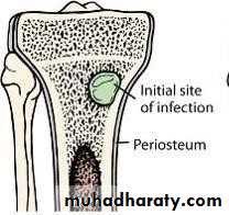 Osteomyelitis