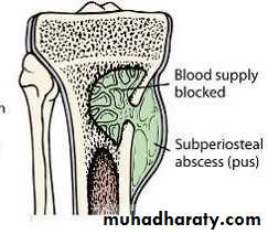 Osteomyelitis