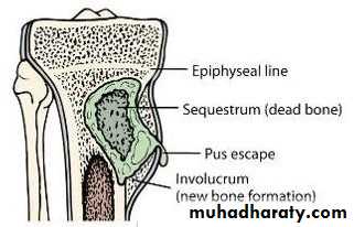 Osteomyelitis