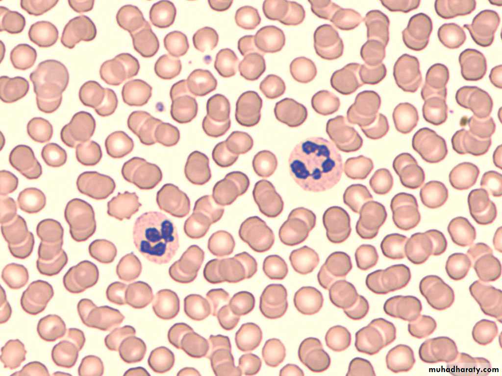 Osteomyelitis