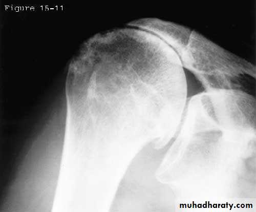 Rotator Cuff Disorders