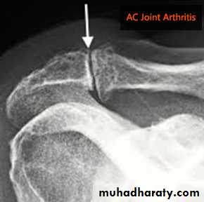 Rotator Cuff Disorders