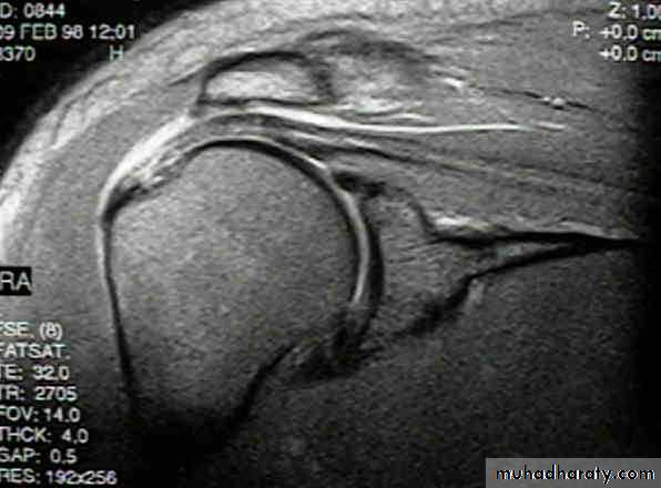 Rotator Cuff Disorders