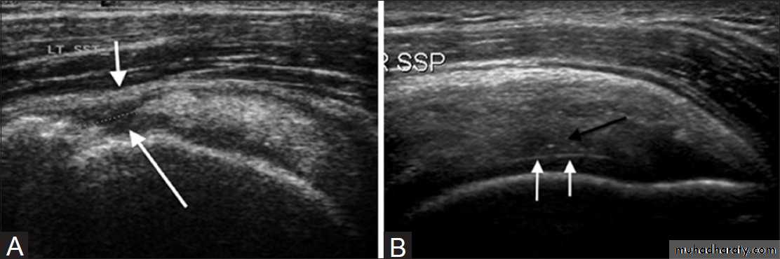 Rotator Cuff Disorders