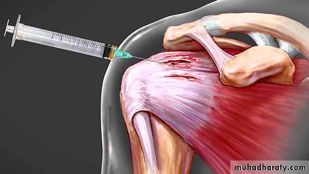 Rotator Cuff Disorders