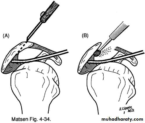 Rotator Cuff Disorders