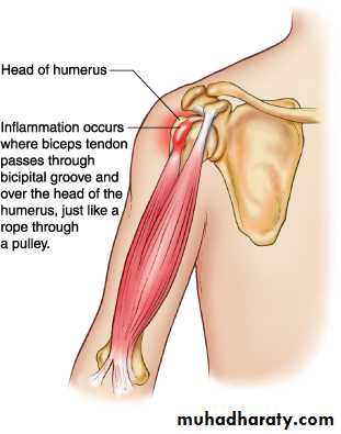 Rotator Cuff Disorders