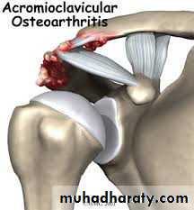 Rotator Cuff Disorders