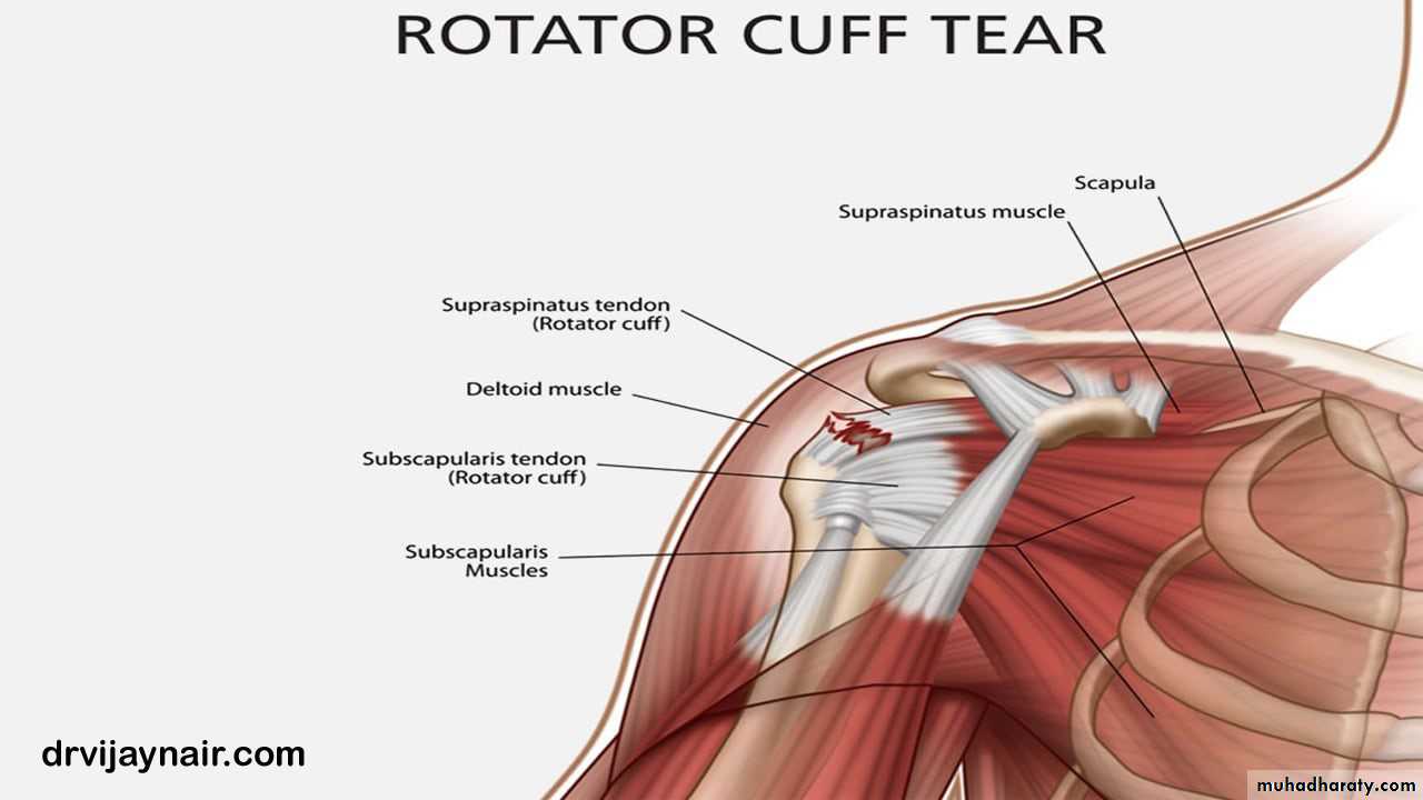 Rotator Cuff Disorders