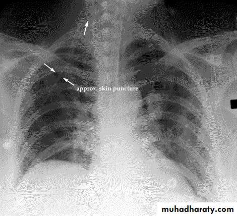 Chest injury