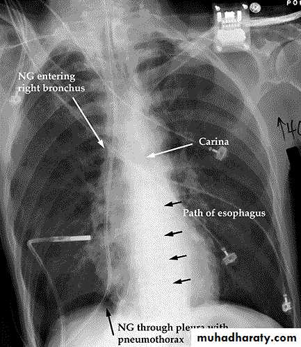 Chest injury