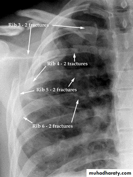 Chest injury