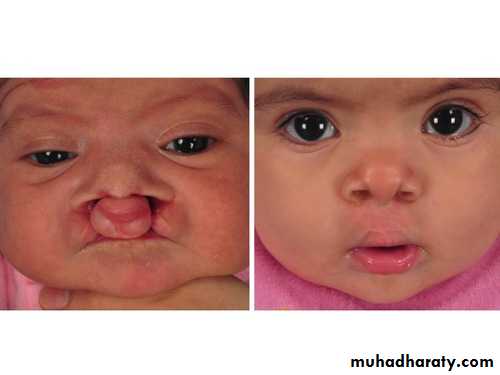 cleft lip and palate
