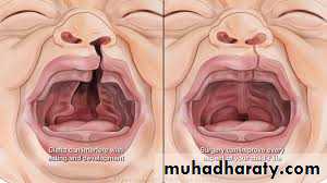cleft lip and palate