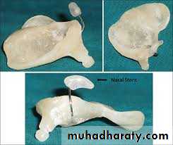 cleft lip and palate
