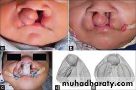 cleft lip and palate