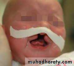 cleft lip and palate