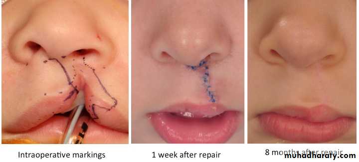 cleft lip and palate