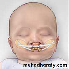 cleft lip and palate