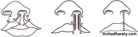 cleft lip and palate