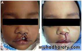 cleft lip and palate