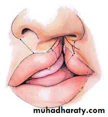 cleft lip and palate