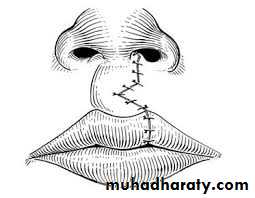 cleft lip and palate