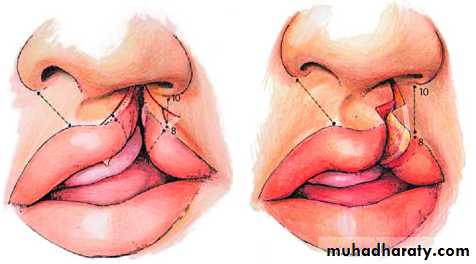 cleft lip and palate