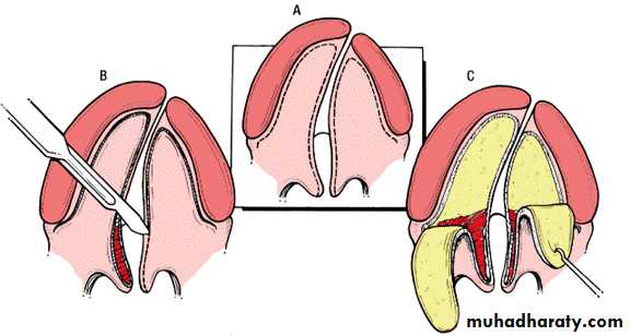 cleft lip and palate