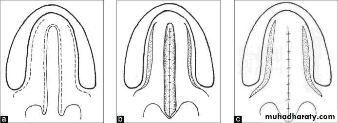 cleft lip and palate