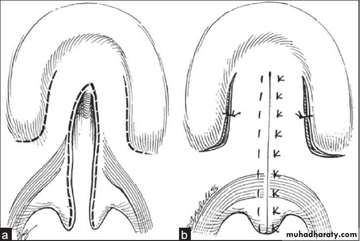 cleft lip and palate