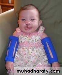 cleft lip and palate
