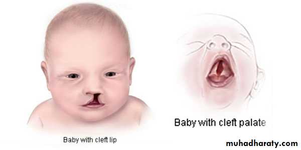 cleft lip and palate