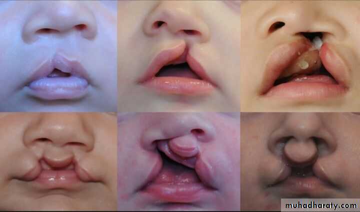 cleft lip and palate