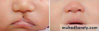 cleft lip and palate