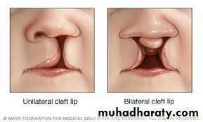 cleft lip and palate