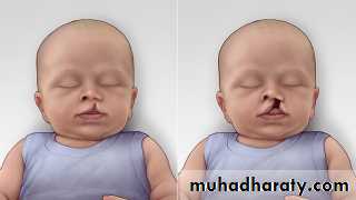 cleft lip and palate