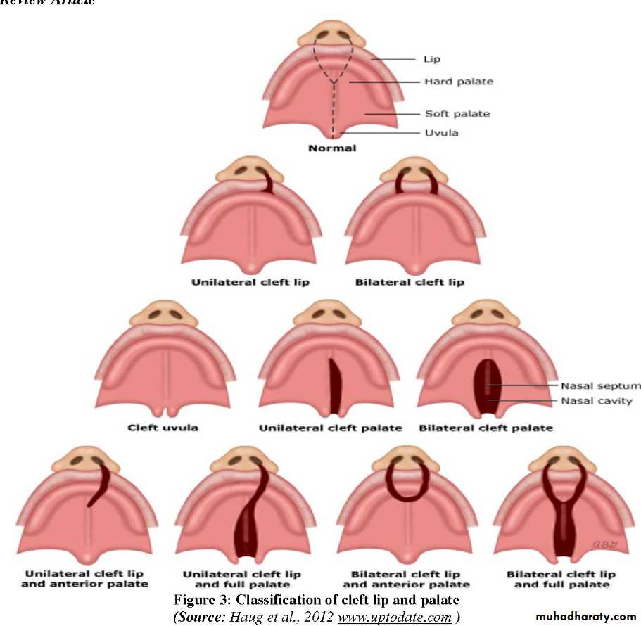 cleft lip and palate