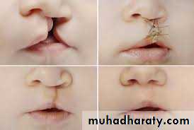 cleft lip and palate