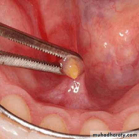 Salivary gland ppt