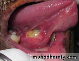 Salivary gland ppt