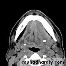 Salivary gland ppt