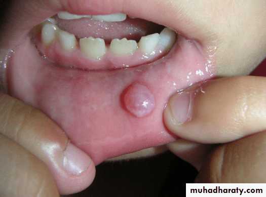 Salivary gland ppt