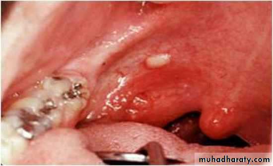 Salivary gland ppt