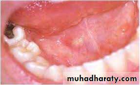 Salivary gland ppt