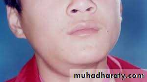 Salivary gland ppt