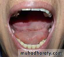 Salivary gland ppt