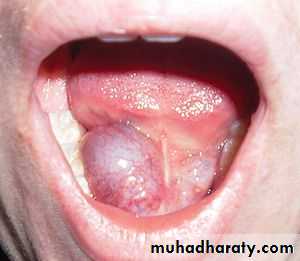 Salivary gland ppt