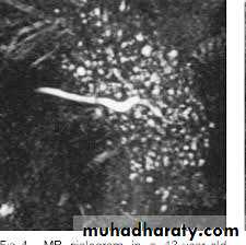 Salivary gland ppt