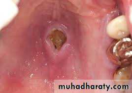 Salivary gland ppt